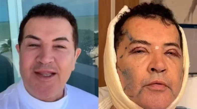 Beto Barbosa exibe recuperação pós-cirúrgica no rosto