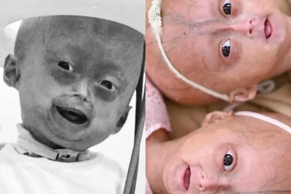 Elis Lima Carneiro morre aos 5 anos e mobiliza seguidores