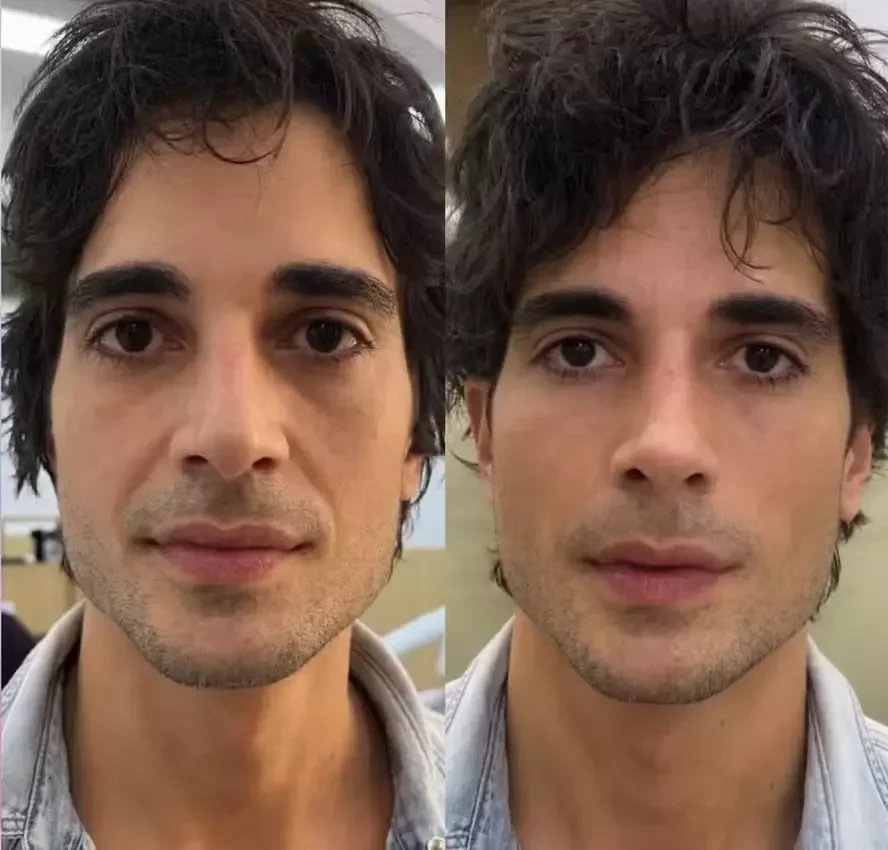 Fiuk mostra antes e depois da harmonização que mudou até o nariz