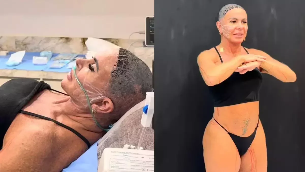 Gretchen recorre a procedimento para combater a flacidez aos 67