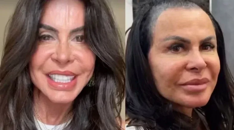 Gretchen: transplante capilar será transmitido ao vivo