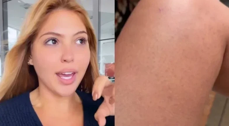 Mariana Menezes inicia tratamento de 4 meses por urticária