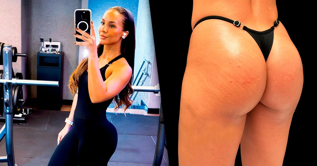 Maxiane exibe resultado da harmonização de glúteos com fotos exclusivas