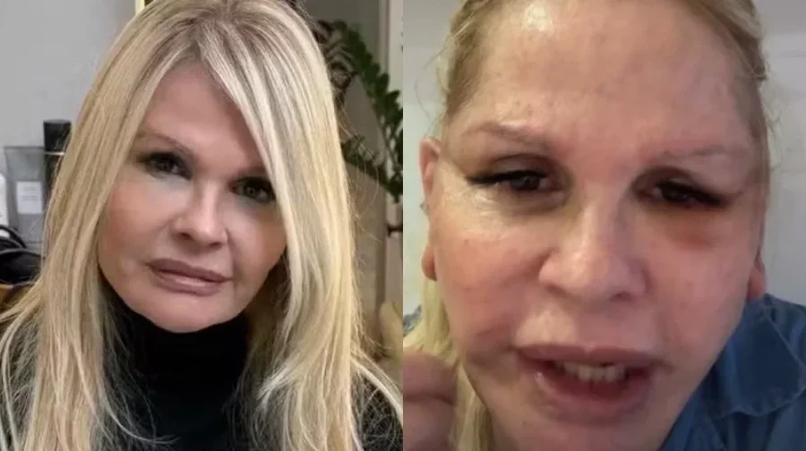 Monique Evans revela motivo da cirurgia e surpreende com relato do banco