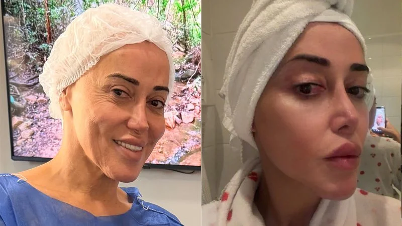 Mulher Abacaxi mostra antes e depois da feminização facial