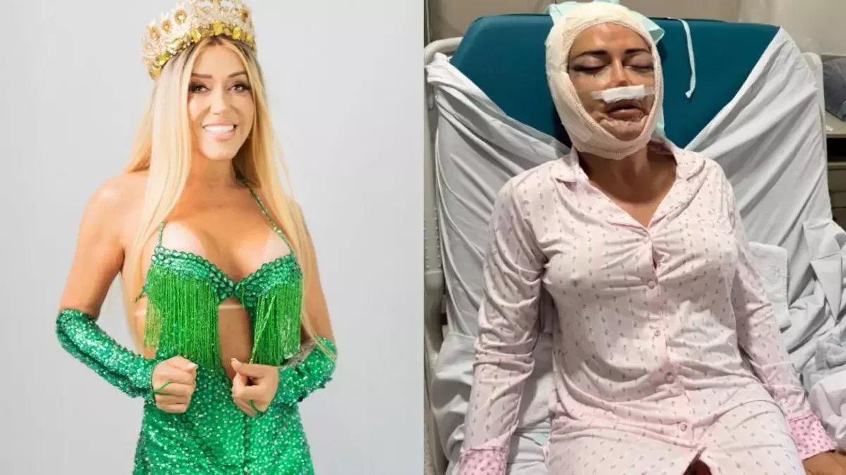 Mulher Abacaxi surge com rosto enfaixado após novo lifting facial