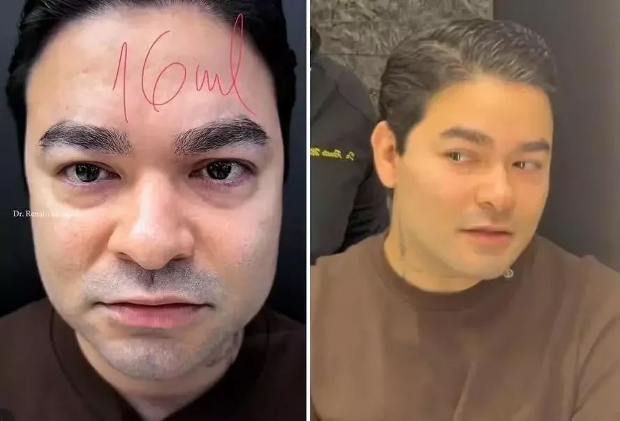 Yudi Tamashiro revela rosto remodelado com 16 ml de ácido